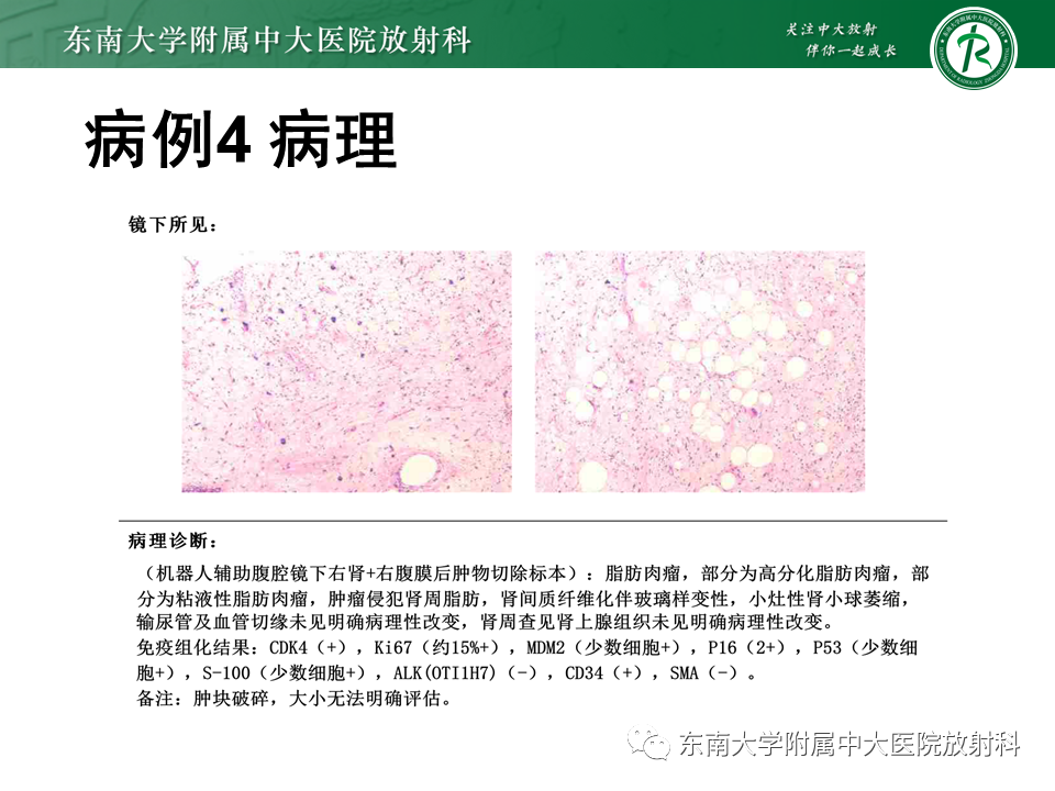 影像PPT - 【PPT】侵袭性血管黏液瘤-34
