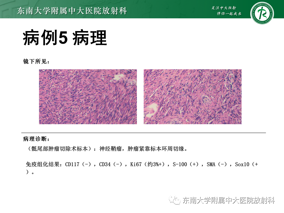 影像PPT - 【PPT】侵袭性血管黏液瘤-38