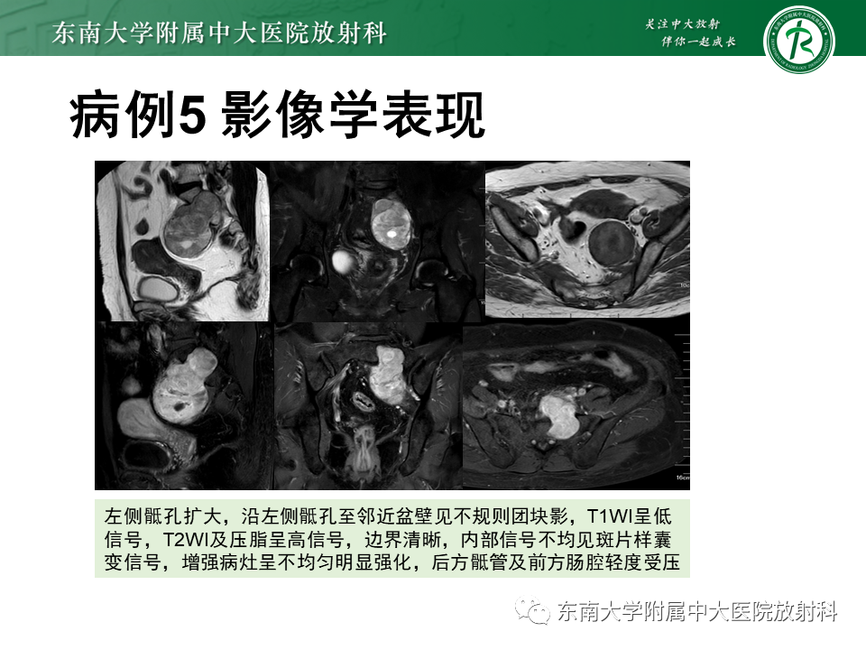 影像PPT - 【PPT】侵袭性血管黏液瘤-37