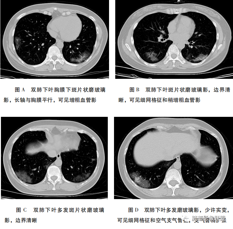 影像PPT - 【病例】新冠肺炎3例早期CT征象分析-3 影像PPT - 【病例】新冠肺炎3例早期CT征象分析-3