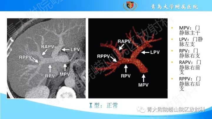 影像PPT - 【PPT】门静脉解剖及变异-7