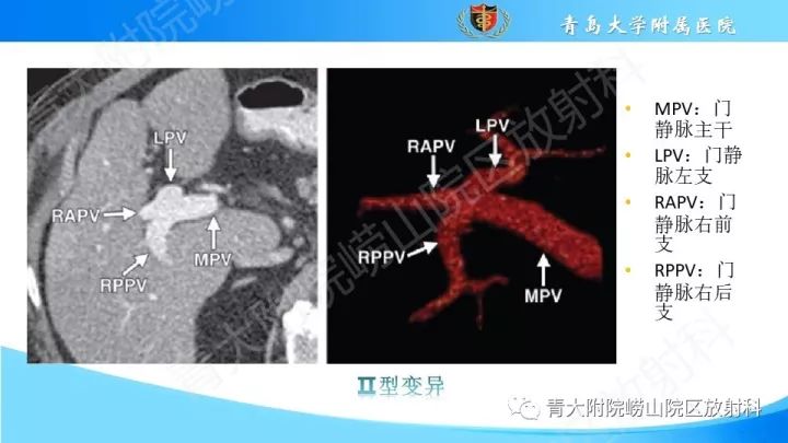 影像PPT - 【PPT】门静脉解剖及变异-9