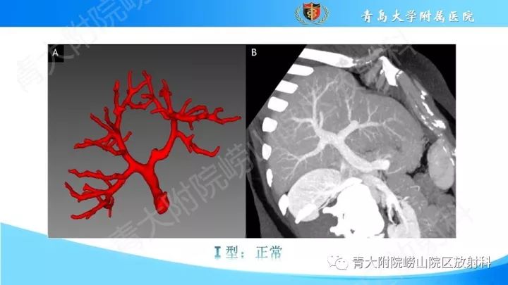 影像PPT - 【PPT】门静脉解剖及变异-8
