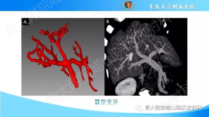 影像PPT - 【PPT】门静脉解剖及变异-10
