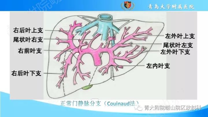 影像PPT - 【PPT】门静脉解剖及变异-4