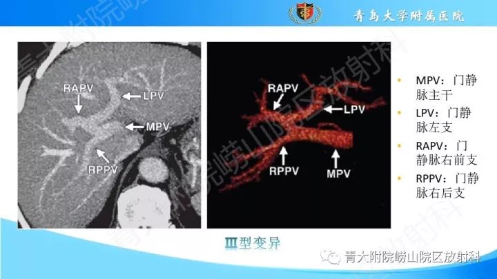 影像PPT - 【PPT】门静脉解剖及变异-11
