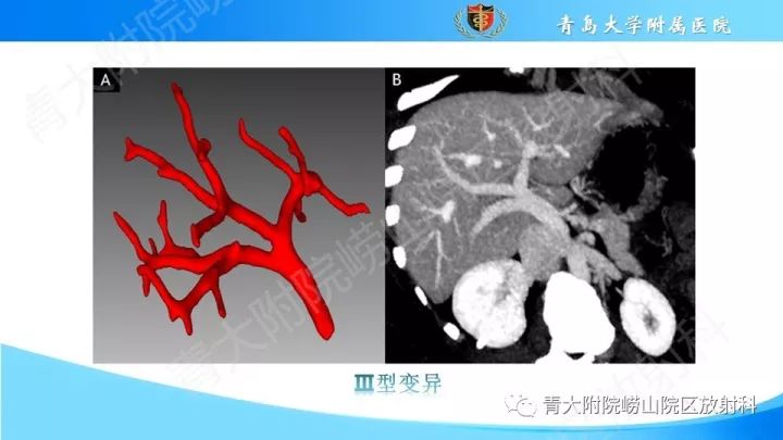 影像PPT - 【PPT】门静脉解剖及变异-12