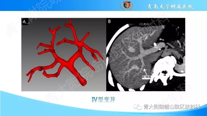 影像PPT - 【PPT】门静脉解剖及变异-13