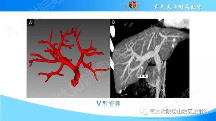 影像PPT - 【PPT】门静脉解剖及变异-14