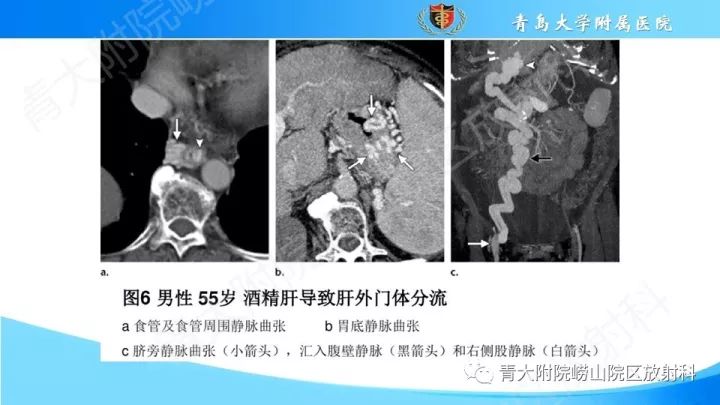 影像PPT - 【PPT】门静脉解剖及变异-19