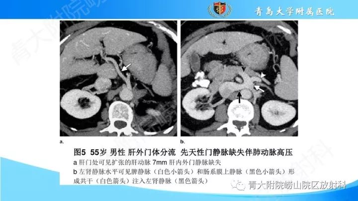 影像PPT - 【PPT】门静脉解剖及变异-17