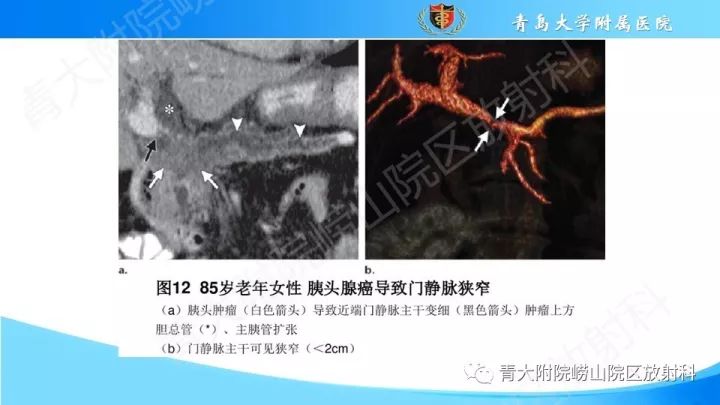 影像PPT - 【PPT】门静脉解剖及变异-21