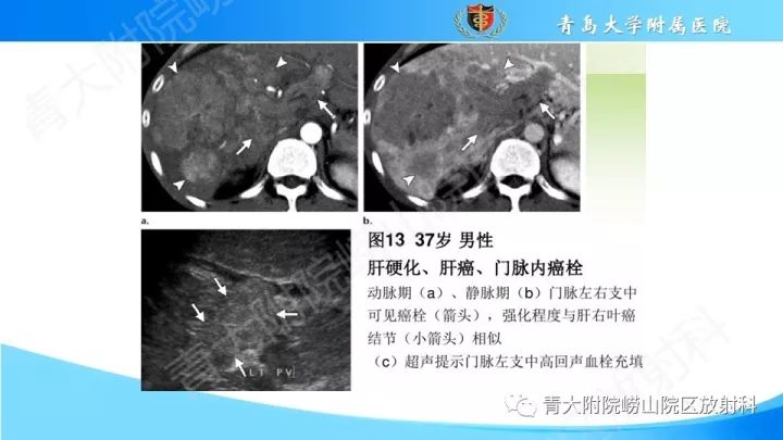 影像PPT - 【PPT】门静脉解剖及变异-23