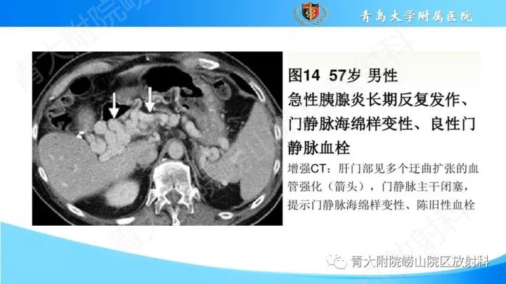 影像PPT - 【PPT】门静脉解剖及变异-25