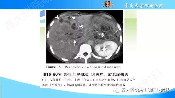 影像PPT - 【PPT】门静脉解剖及变异-27