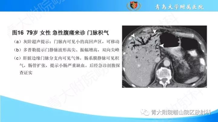 影像PPT - 【PPT】门静脉解剖及变异-29