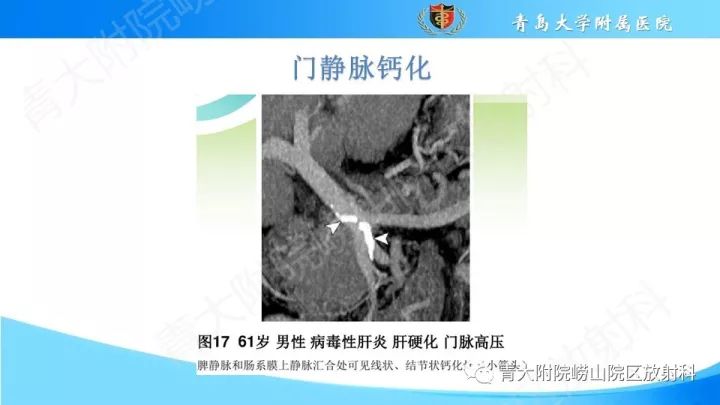 影像PPT - 【PPT】门静脉解剖及变异-30