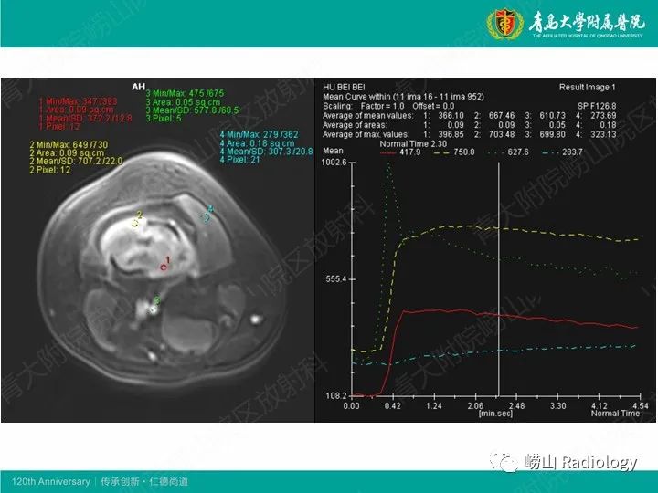 影像PPT - 【病例】股骨尤文肉瘤1例CT及MR影像-6