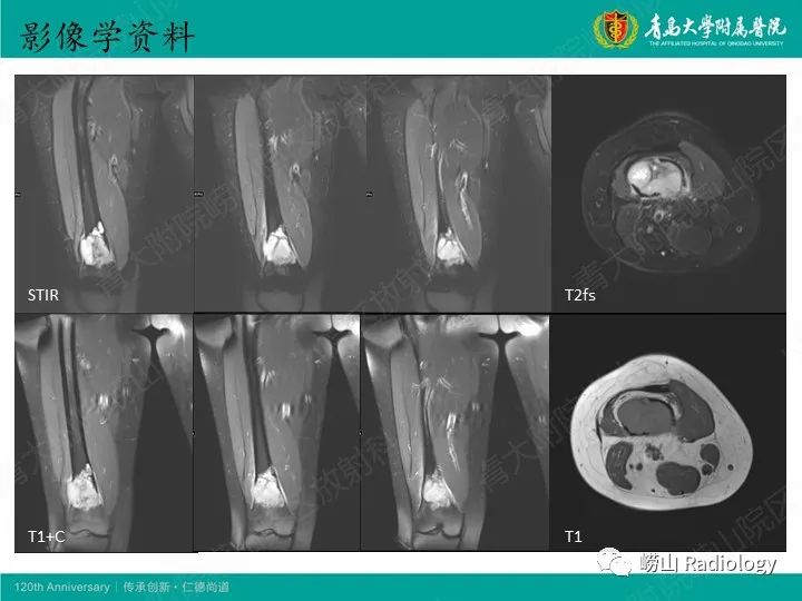 影像PPT - 【病例】股骨尤文肉瘤1例CT及MR影像-5