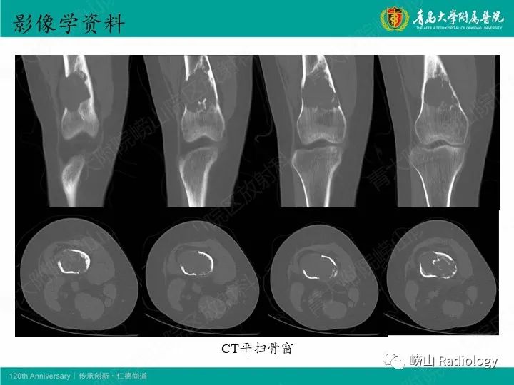 影像PPT - 【病例】股骨尤文肉瘤1例CT及MR影像-3