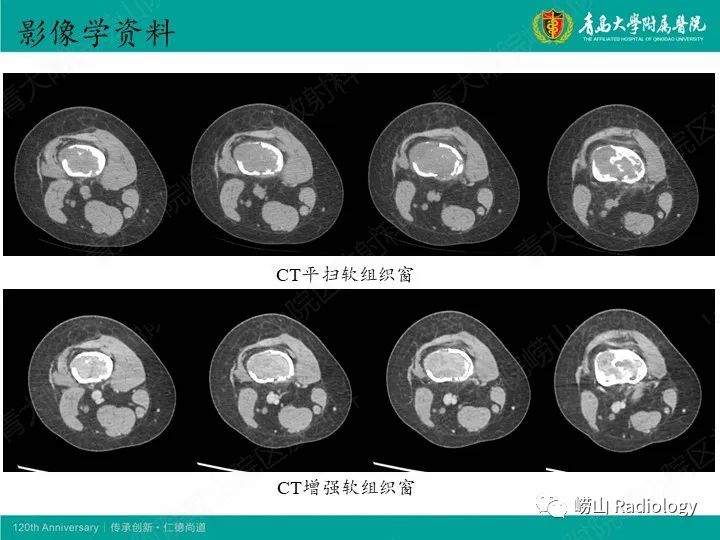影像PPT - 【病例】股骨尤文肉瘤1例CT及MR影像-4