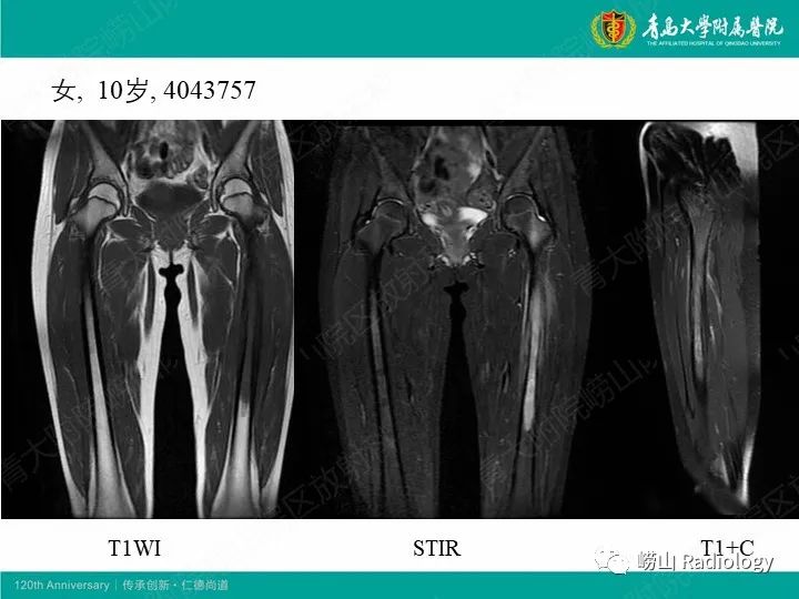 影像PPT - 【病例】股骨尤文肉瘤1例CT及MR影像-14