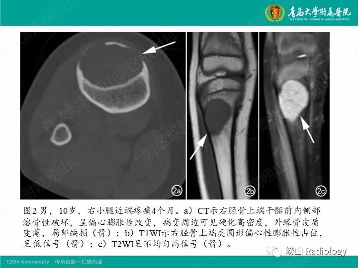 影像PPT - 【病例】股骨尤文肉瘤1例CT及MR影像-16