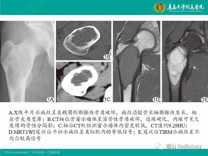 影像PPT - 【病例】股骨尤文肉瘤1例CT及MR影像-18
