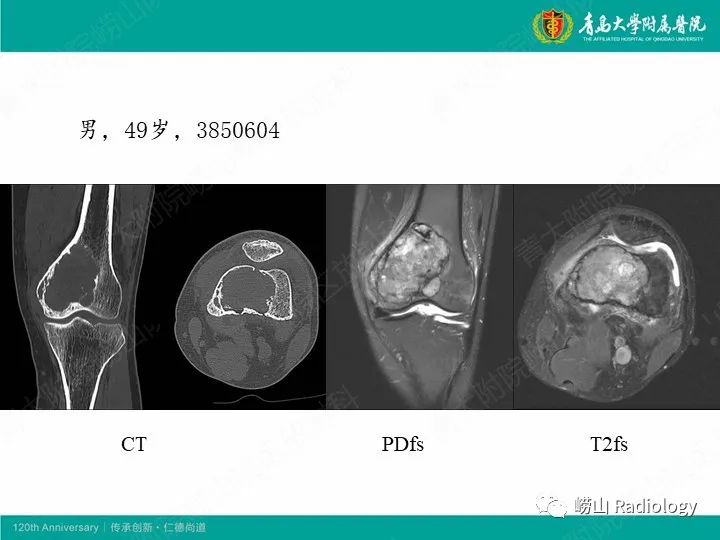 影像PPT - 【病例】股骨尤文肉瘤1例CT及MR影像-20