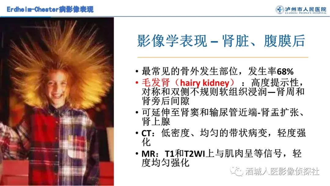 影像PPT - 【PPT】Erdheim-Chester 病（ECD）影像表现-12