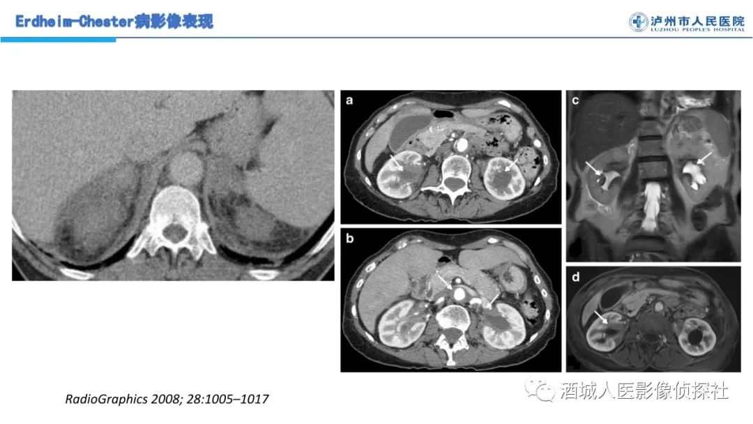 影像PPT - 【PPT】Erdheim-Chester 病（ECD）影像表现-15