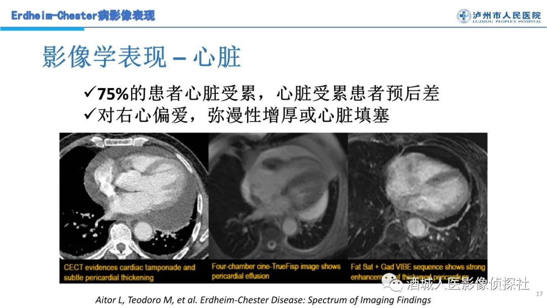 影像PPT - 【PPT】Erdheim-Chester 病（ECD）影像表现-17