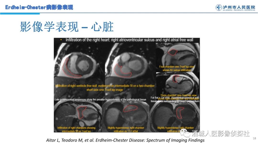 影像PPT - 【PPT】Erdheim-Chester 病（ECD）影像表现-18