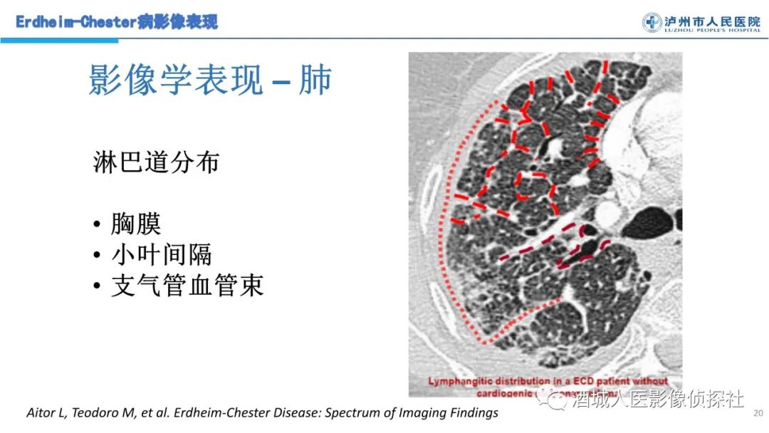 影像PPT - 【PPT】Erdheim-Chester 病（ECD）影像表现-20