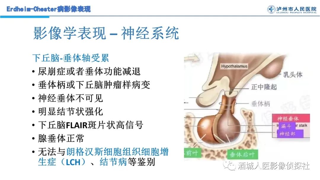 影像PPT - 【PPT】Erdheim-Chester 病（ECD）影像表现-22