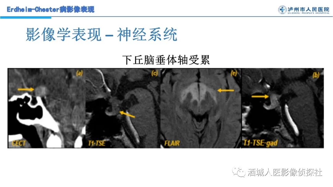 影像PPT - 【PPT】Erdheim-Chester 病（ECD）影像表现-23