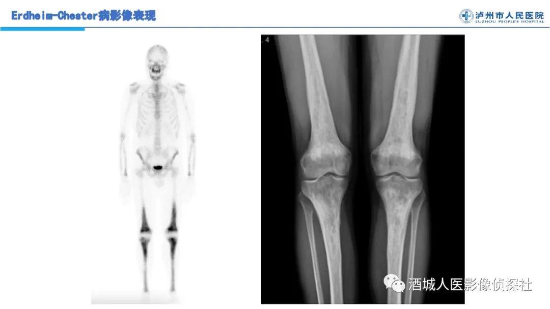 影像PPT - 【PPT】Erdheim-Chester 病（ECD）影像表现-10
