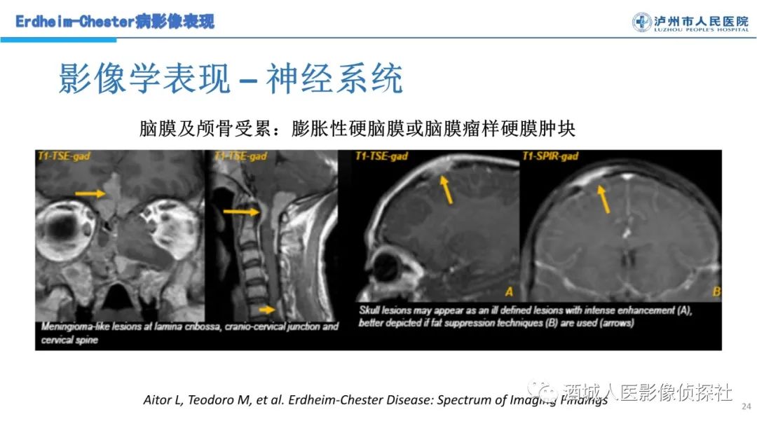 影像PPT - 【PPT】Erdheim-Chester 病（ECD）影像表现-24