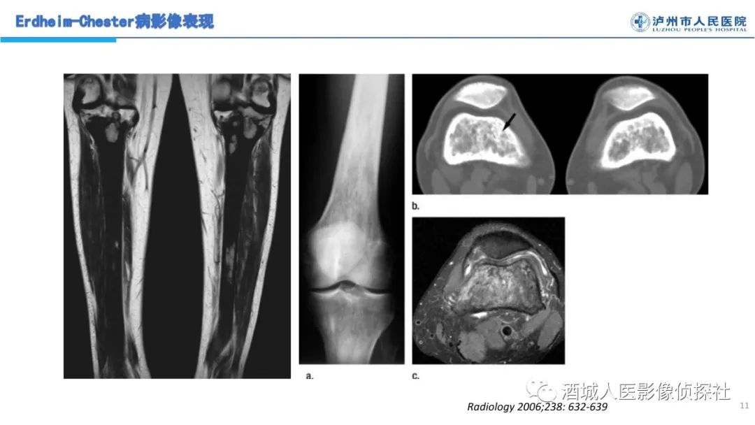 影像PPT - 【PPT】Erdheim-Chester 病（ECD）影像表现-11