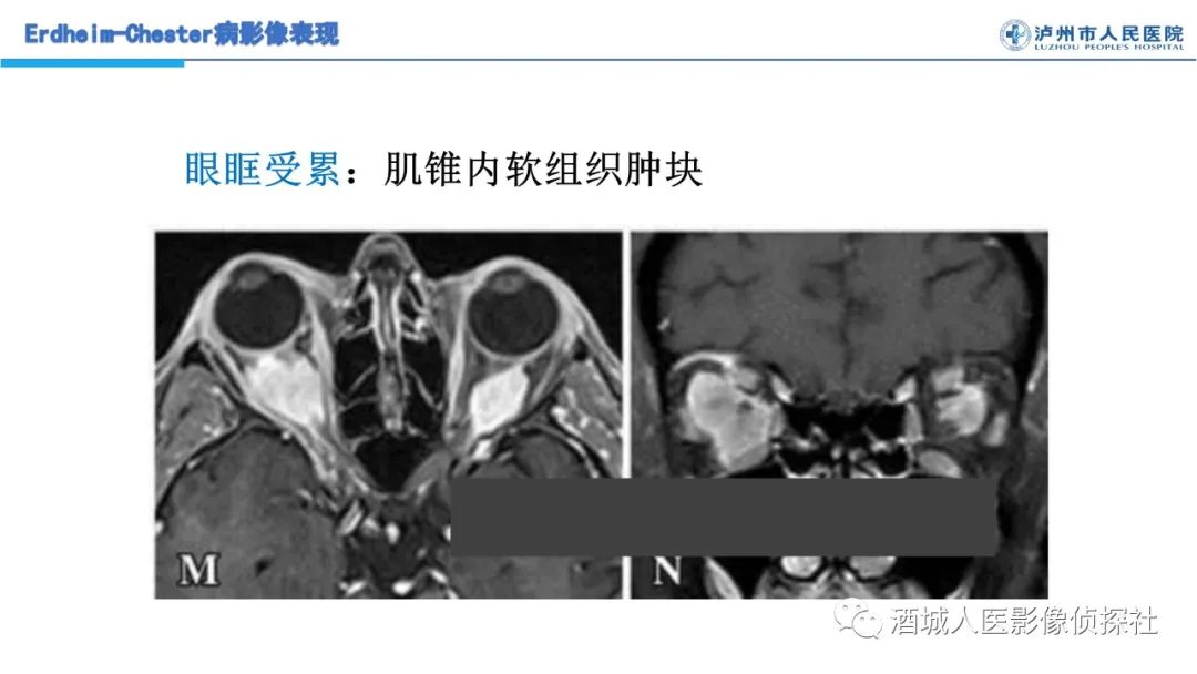 影像PPT - 【PPT】Erdheim-Chester 病（ECD）影像表现-25