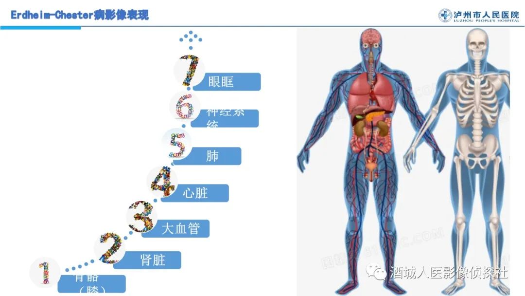 影像PPT - 【PPT】Erdheim-Chester 病（ECD）影像表现-26