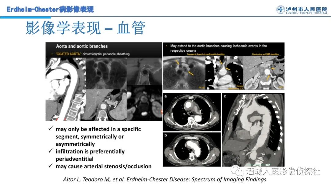 影像PPT - 【PPT】Erdheim-Chester 病（ECD）影像表现-16