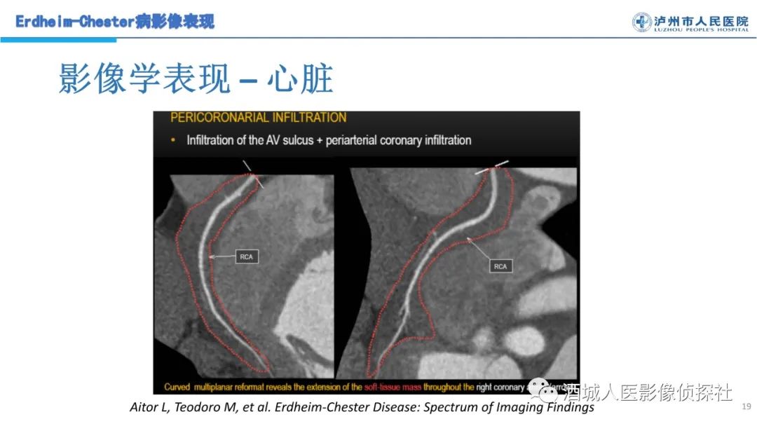 影像PPT - 【PPT】Erdheim-Chester 病（ECD）影像表现-19