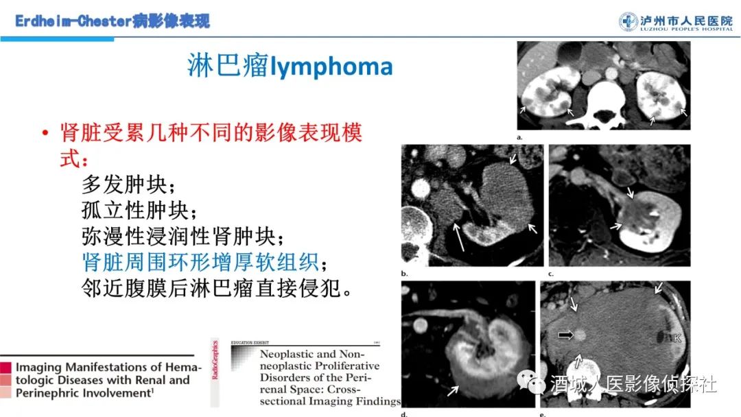 影像PPT - 【PPT】Erdheim-Chester 病（ECD）影像表现-32