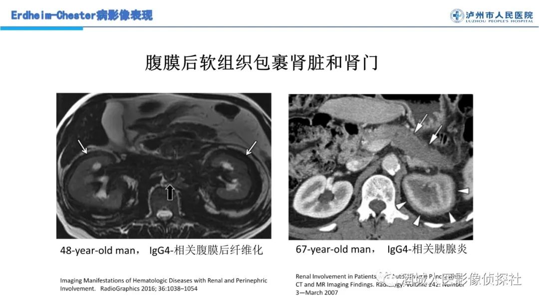 影像PPT - 【PPT】Erdheim-Chester 病（ECD）影像表现-36
