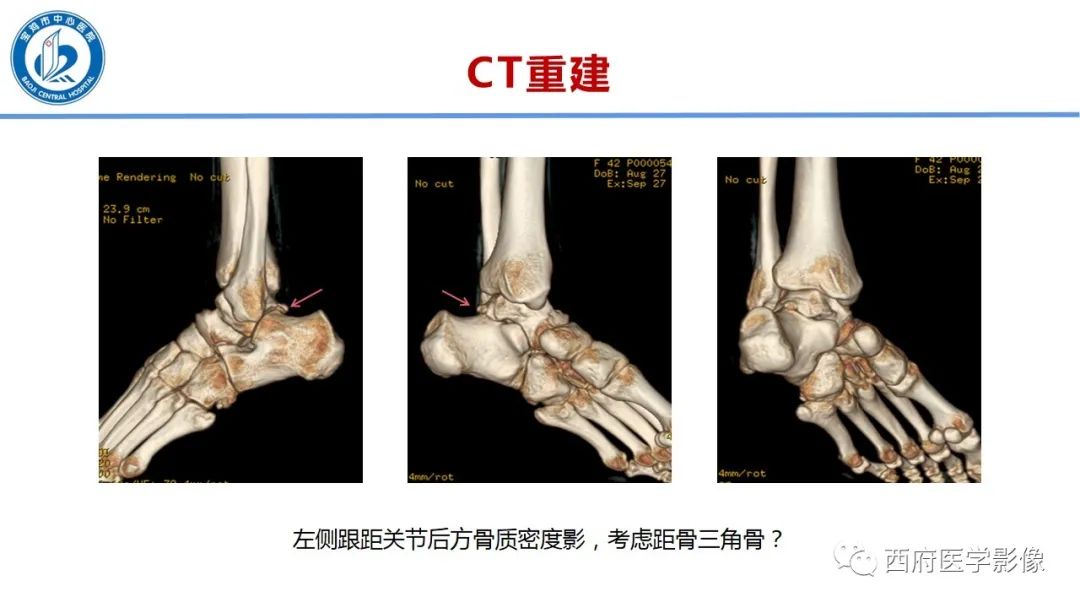 影像PPT - 【PPT】距后三角籽骨综合征影像诊断-7