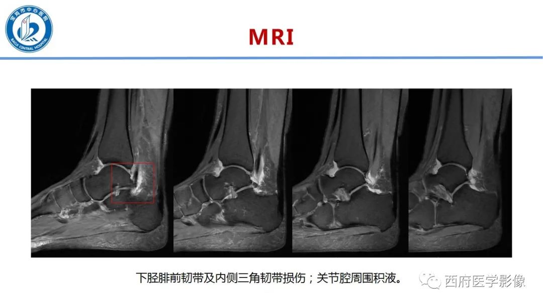 影像PPT - 【PPT】距后三角籽骨综合征影像诊断-9