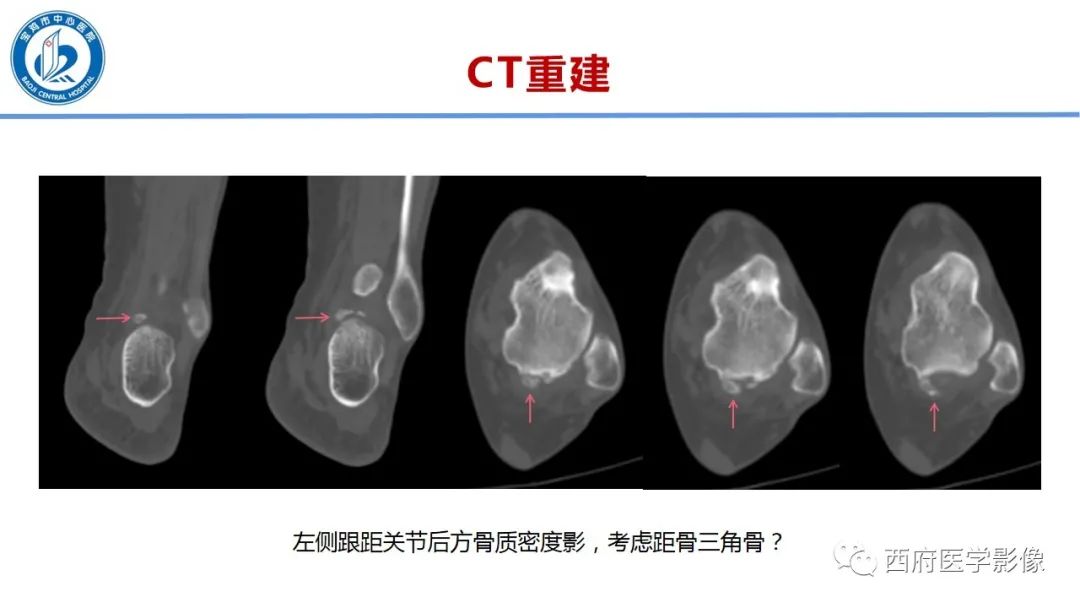 影像PPT - 【PPT】距后三角籽骨综合征影像诊断-6