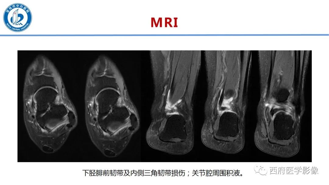 影像PPT - 【PPT】距后三角籽骨综合征影像诊断-10