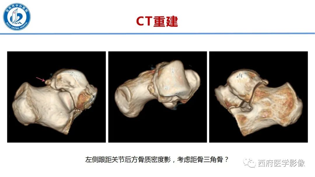 影像PPT - 【PPT】距后三角籽骨综合征影像诊断-8